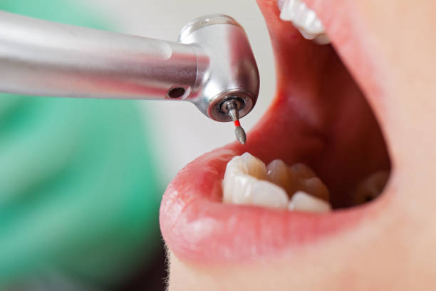 Best Emergency Dental Care for Broken or Chipped Teeth in Lyman, WY